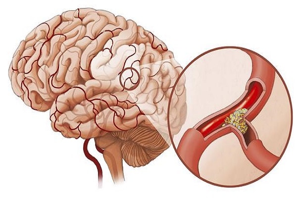 Bệnh tai biến mạch máu não